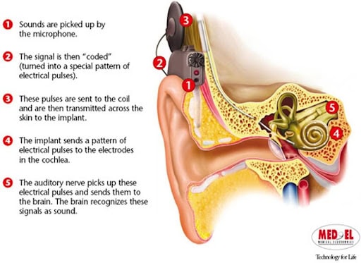 Cochlear Implants